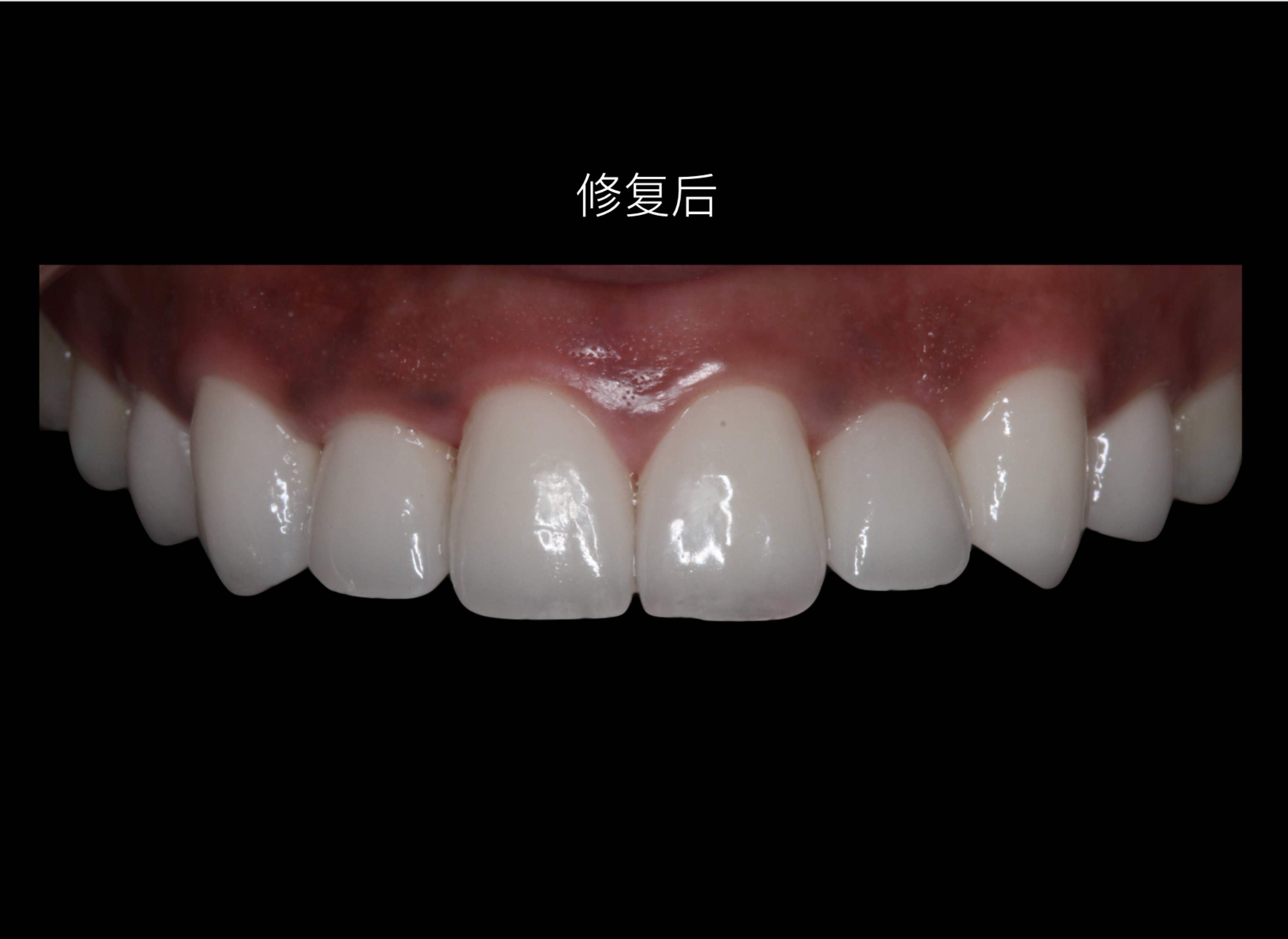 美学修复病例欣赏