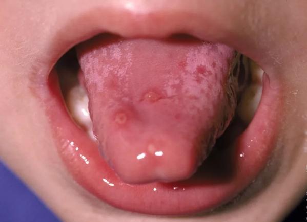 也可见周围有红晕中间灰白色的椭圆形疱疹样皮疹;而口腔疱疹常可以