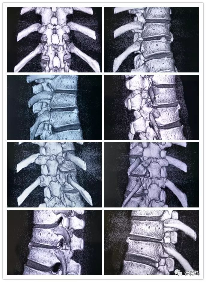 胸11-12椎间盘突出,钙化的脊柱内镜治疗