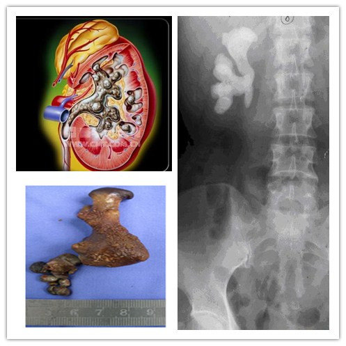 否则可能引起医生的误会认为你是得过肾脏内部的结石