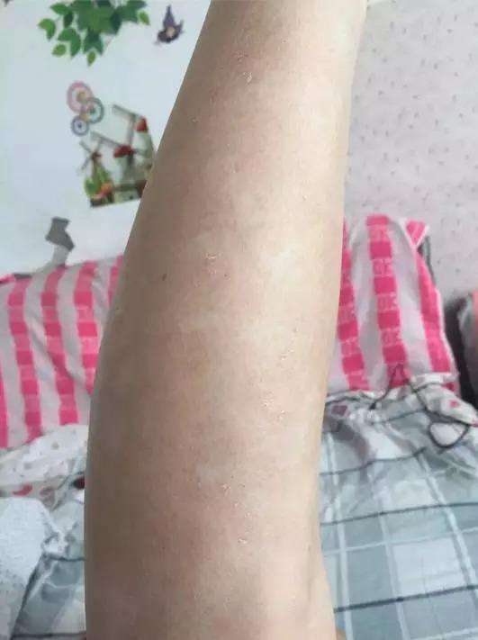 还要关注四肢和头部的皮屑护理,采取恰当的护理手段加快牛皮癣消退