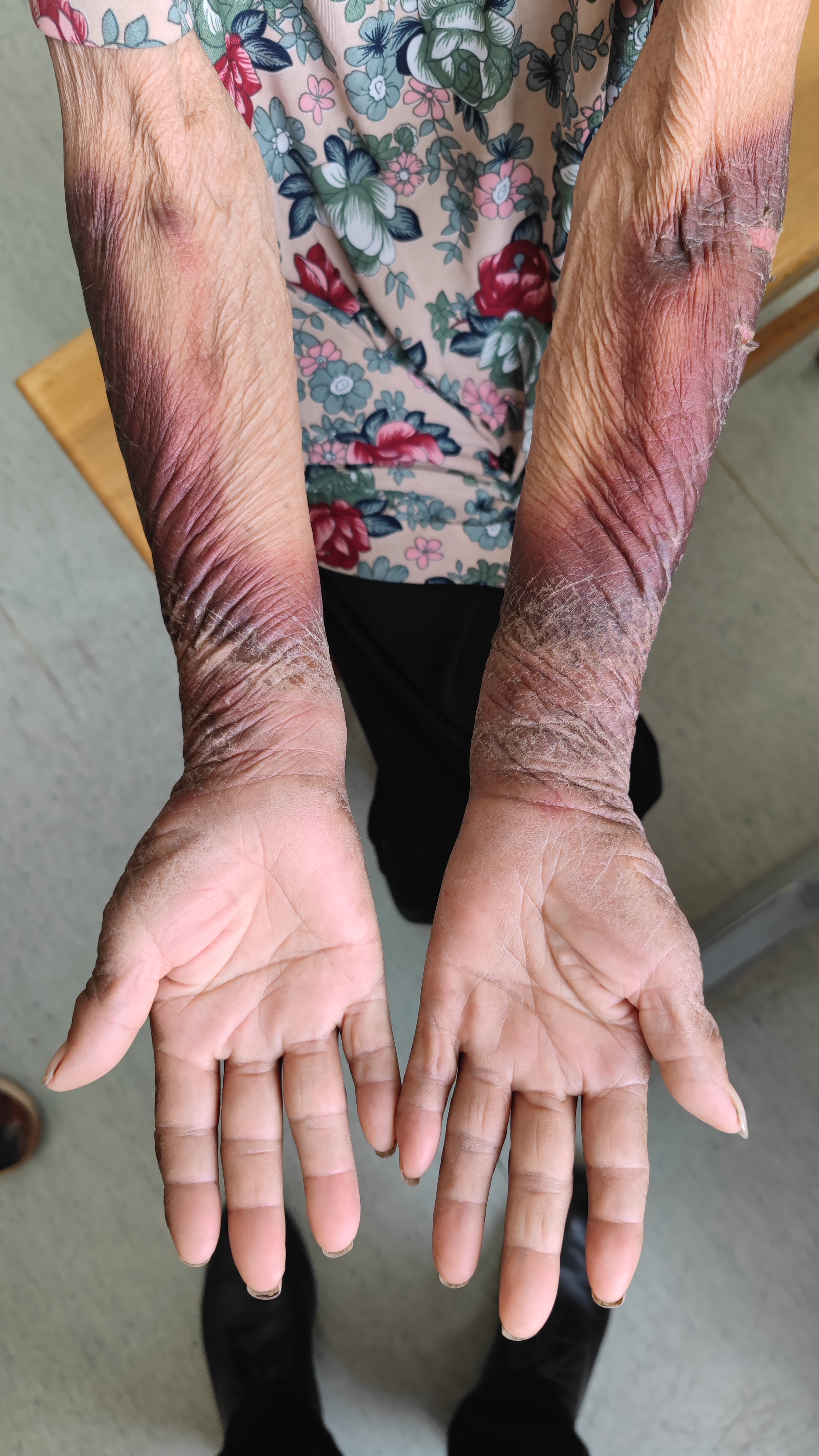 烟酸缺乏症又称糙皮病,是因烟酸类维生素缺乏,临床以皮炎,舌炎,肠炎