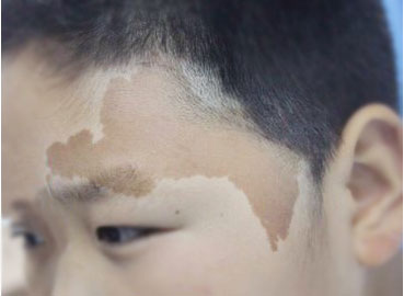 各种面部色斑的治疗