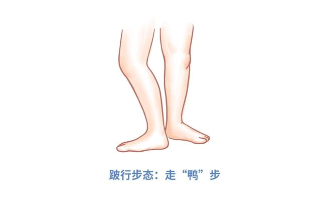 臀纹,腿纹不对称,走鸭步宝宝是否髋关节脱位?