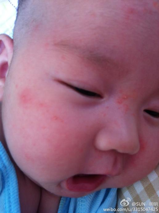 晒热疹,子热疹图片,婴儿热疹_大山谷图库