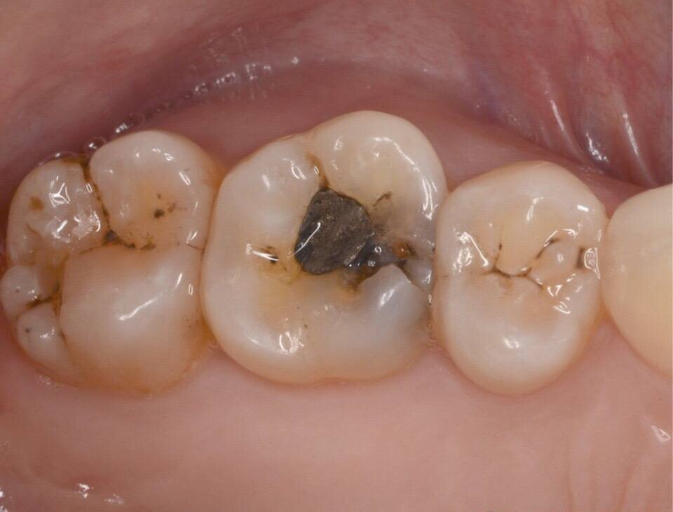 2,银汞充填体和牙齿窝洞之间的微渗漏较大,比较容易出现继发龋坏;1,和