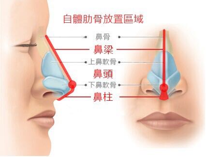 肋骨鼻可以用别人的吗 罗梅副主任医师 爱问医生