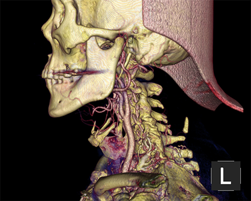 头颈动脉cta,是通过静脉注射造影剂后行ct扫描,得到的头颈部血管