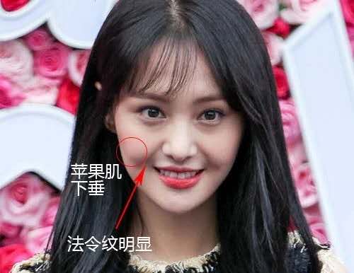 导致苹果肌下垂的主要因素有: 一,先天因素原因:先天脸部骨骼