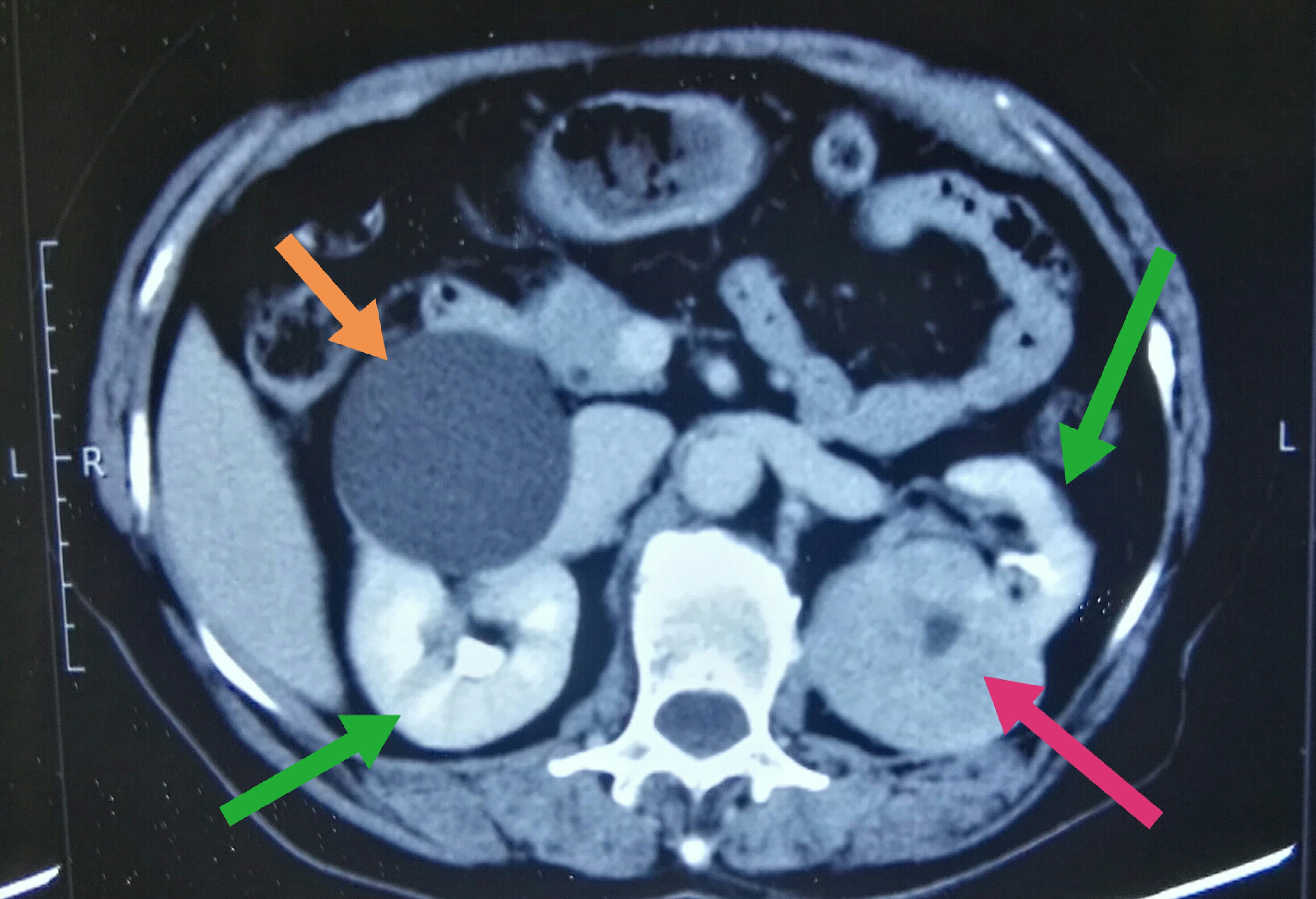 多发肾囊肿ct图片图片