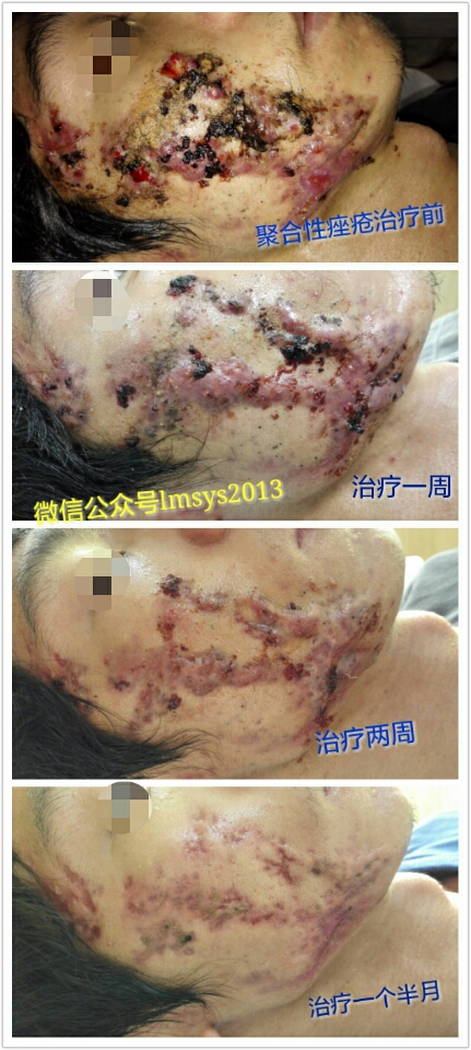 恢复不错,但仍然留下了一些疤痕.