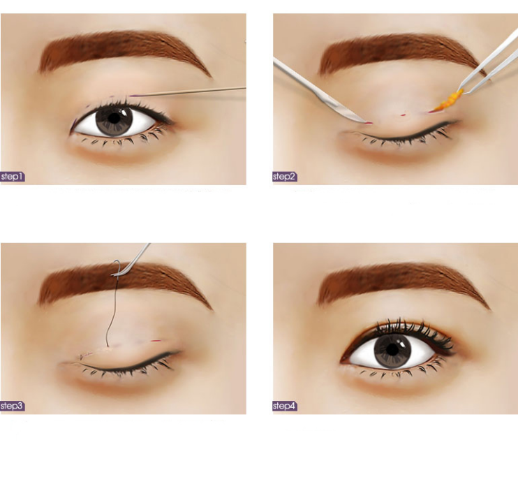 那些花里胡哨的双眼皮手术名,到底啥意思?