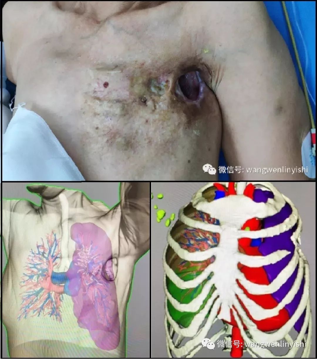 数字重建技术在胸壁外科中的应用