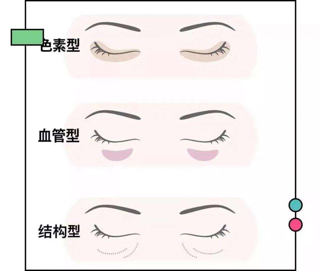 黑眼圈应该如何消除 于燕副主任医师 爱问医生