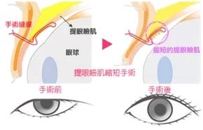 判断上睑下垂看这篇就够了