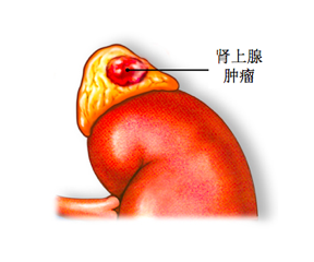 肾上腺肿瘤