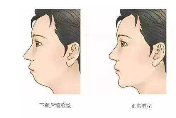 下颌后缩 鸟嘴