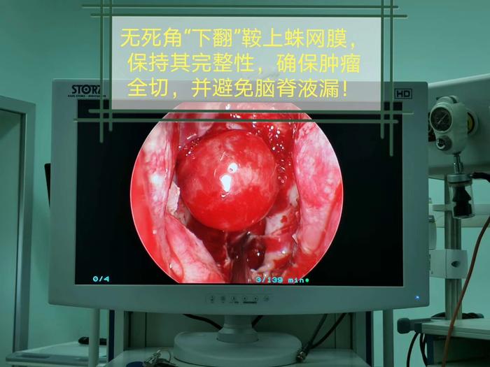 神经内镜下经蝶入路微创手术全切巨大垂体瘤