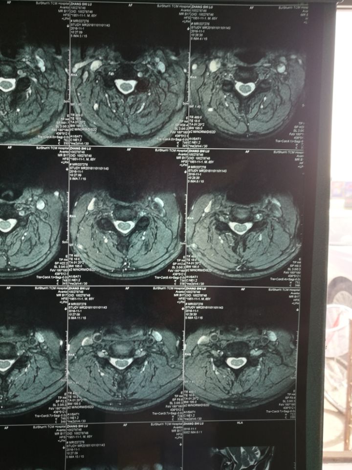 神经根型颈椎病ct图片图片