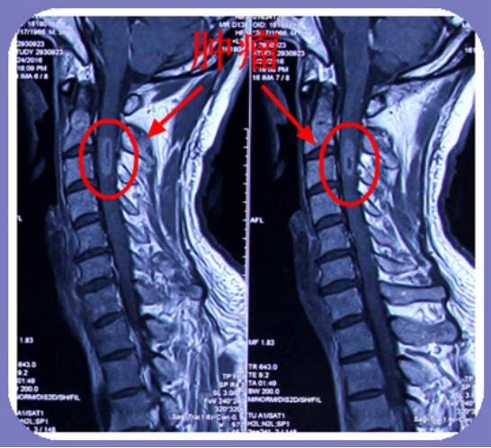 腰椎星形细胞瘤影像图图片