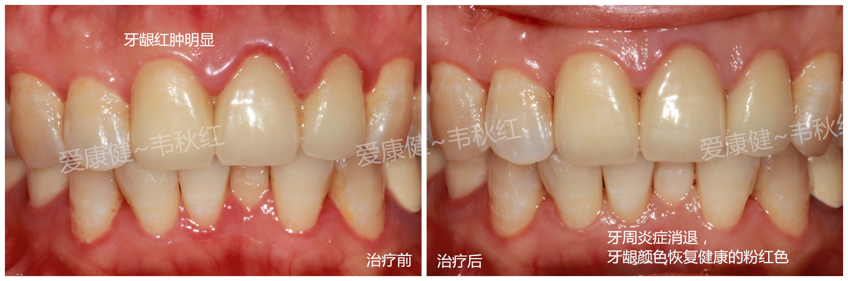 牙周治疗前后图片图片