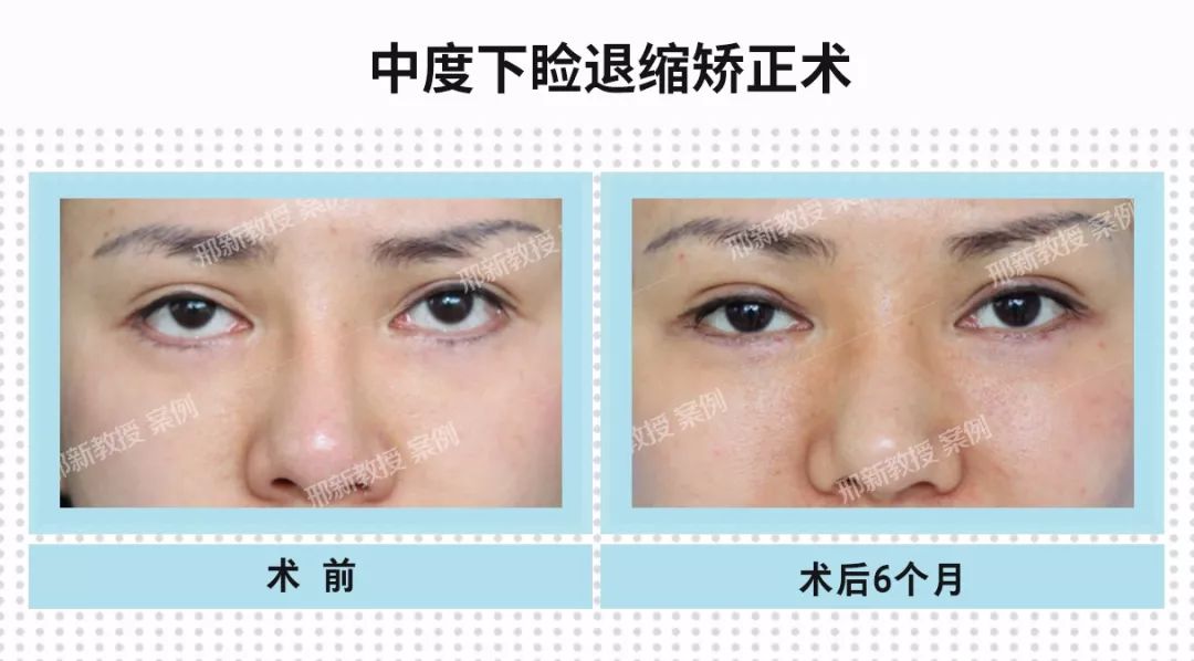 下睑成形术后下睑退缩的矫正及典型病例