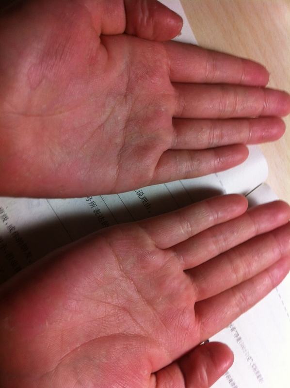 只有少数病人发现和身体他处的霉菌感染或金属过敏甚至情绪压力有关