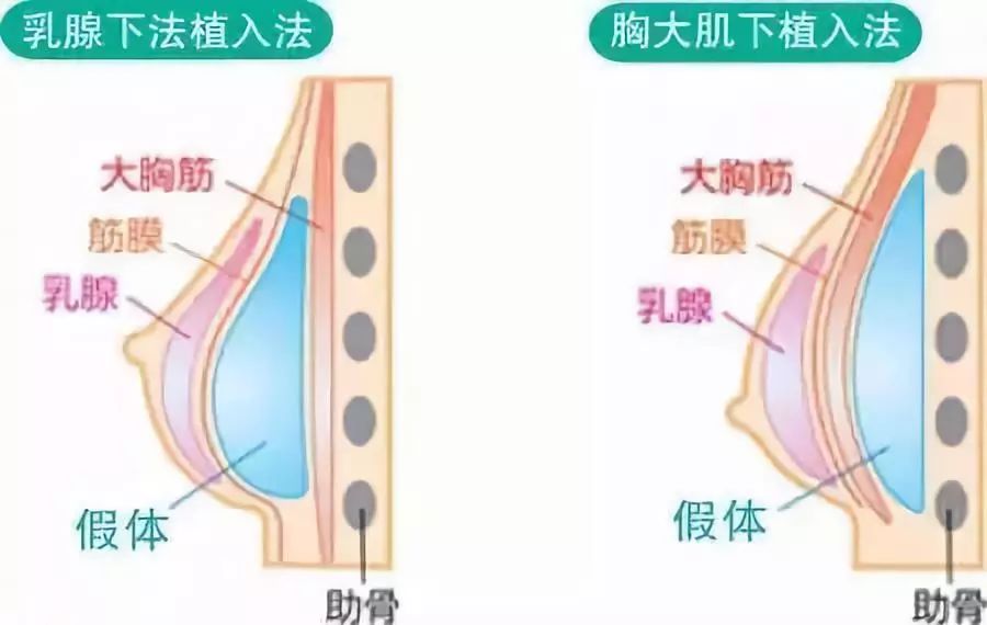 【技术贴】胸要多大才合适?圆形,水滴型假体怎么选?