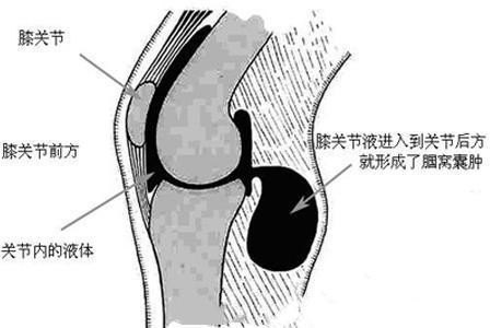 腿部囊肿怎么治疗图片