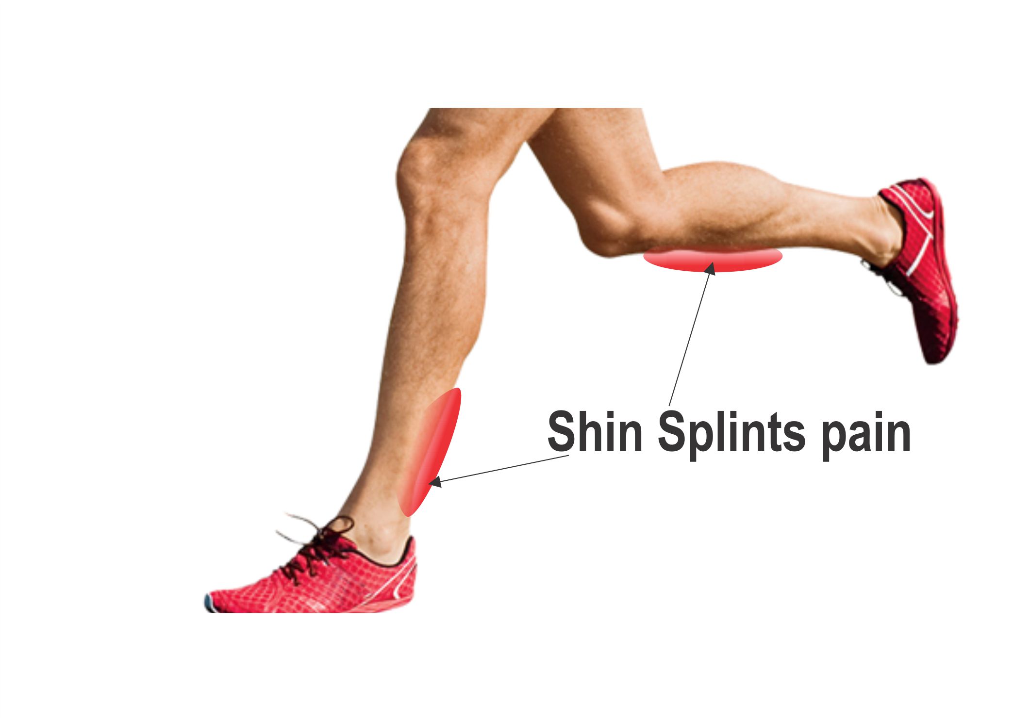 shin-splints-3.jpg