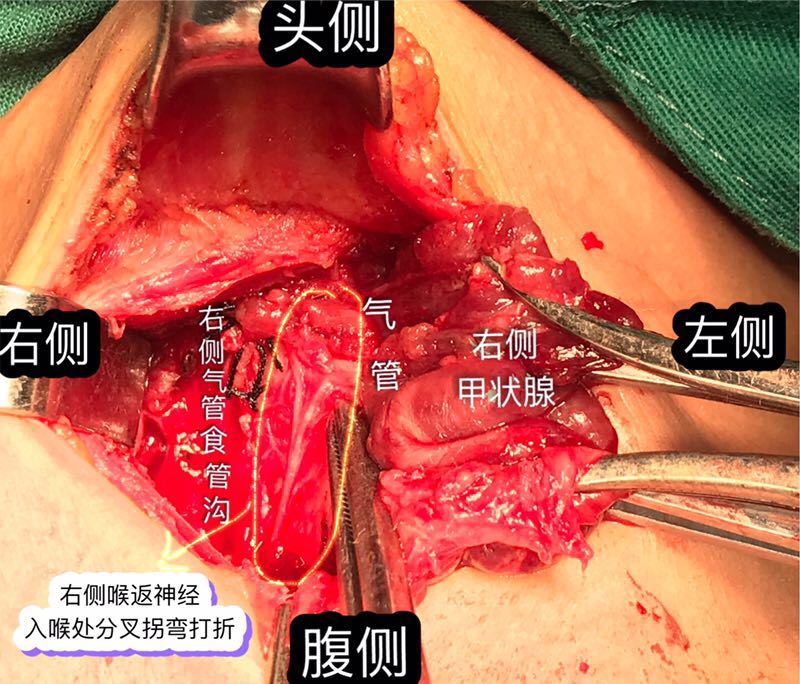 甲狀腺全切後,將標本送冰凍切片,病理報告為:雙側甲狀腺乳頭狀癌.