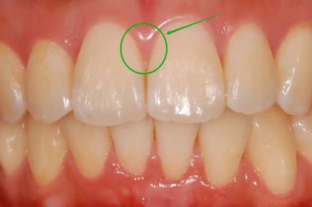 牙龈出血?牙缝变大?千万别小看这些问题!