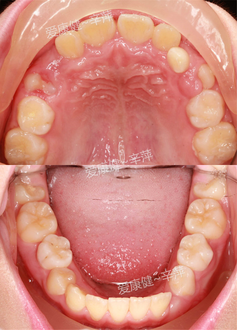 前牙反颌;10岁的小曦因地包天来诊要求矫治,检查后诊断其属"混合牙列