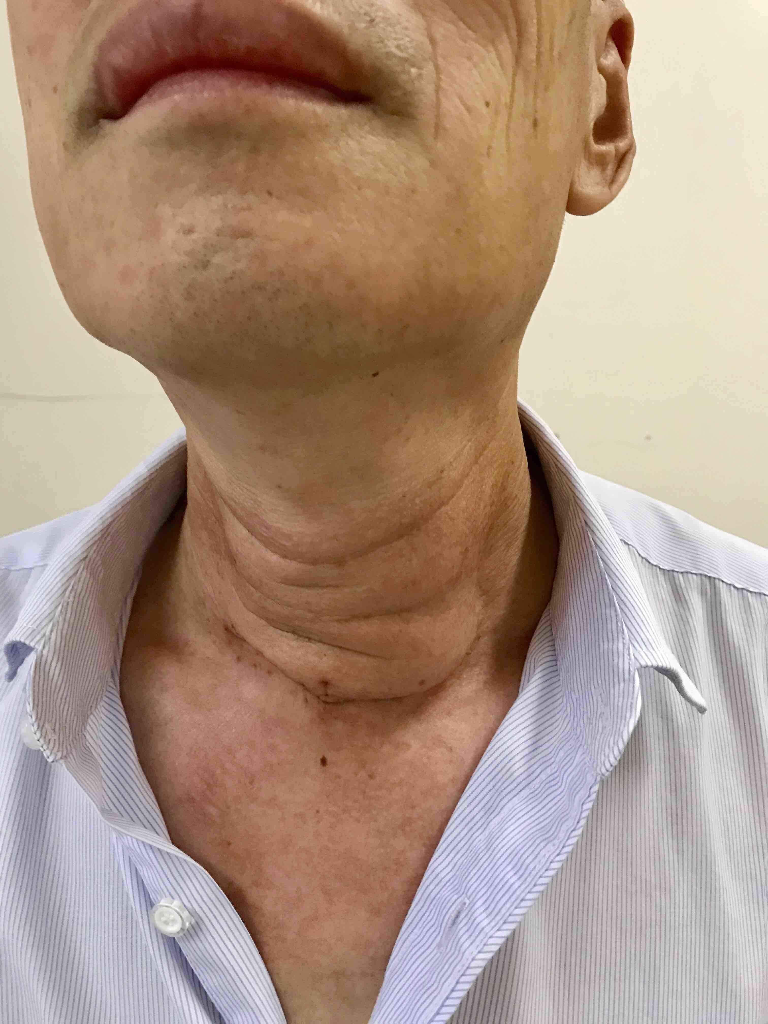 李连杰过度衰老是甲亢引起的吗?