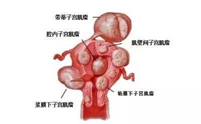 多发性子宫肌瘤,巨大子宫的手术,如何能做到腹部没有一个伤口?
