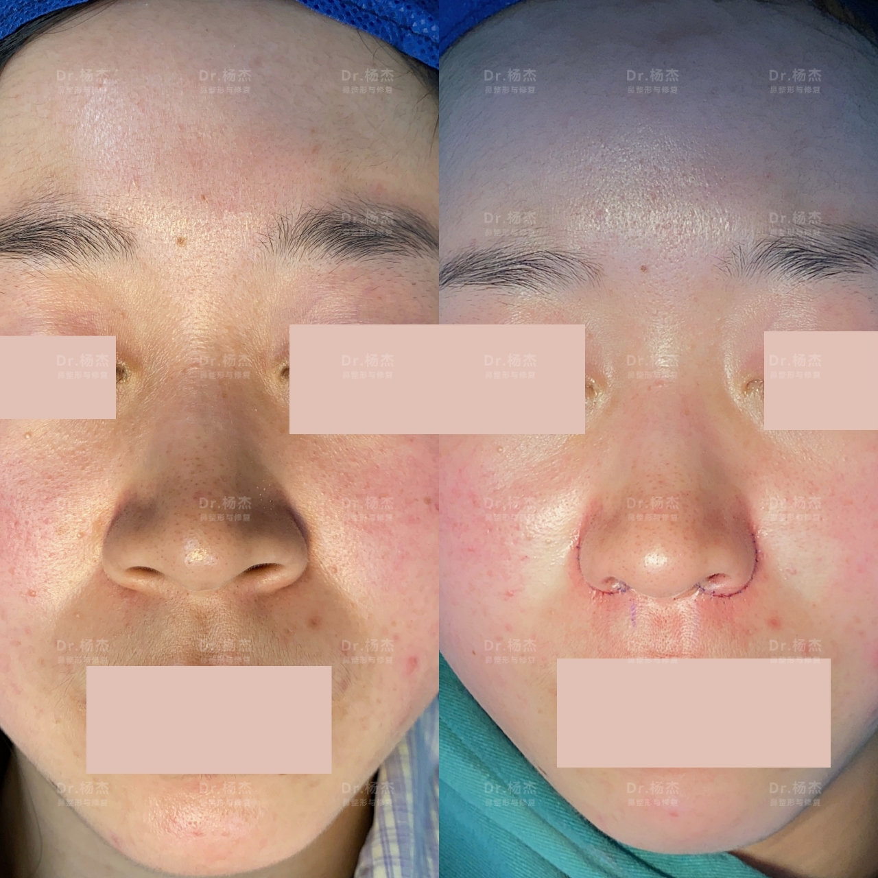 内外联合鼻翼缩小