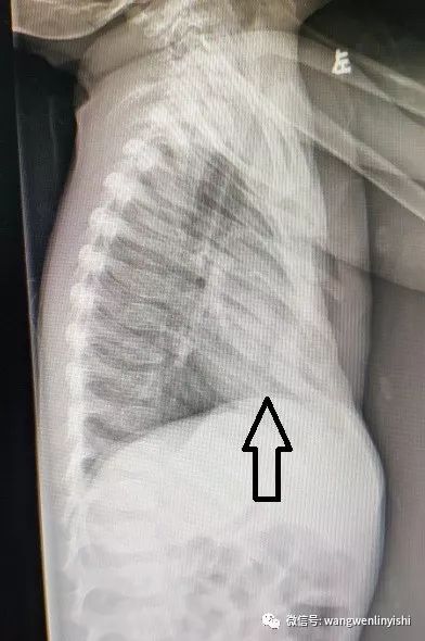 2岁半poland综合征患儿第5次手术wang手术