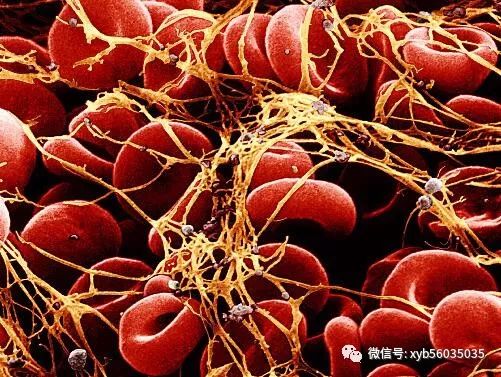 溶血性贫血治疗方案多多治愈方案却只有一个