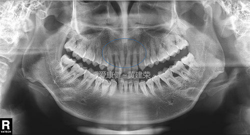 这是一个牙周病导致牙齿严重移位的复杂案例,经过系统分析后,建议