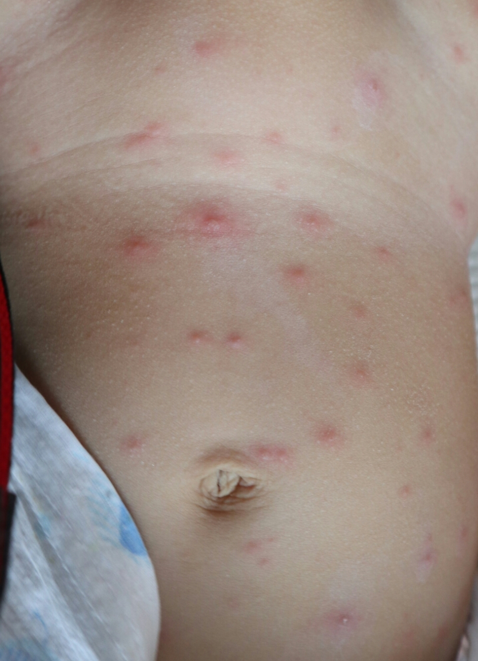 大于12岁以上的人群及孕妇,免疫功能不全的患者,患有水痘建议抗病毒
