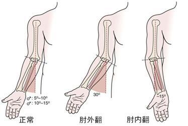 辟谣:肘内翻的畸形矫正要等成年之后?错,及时矫正!