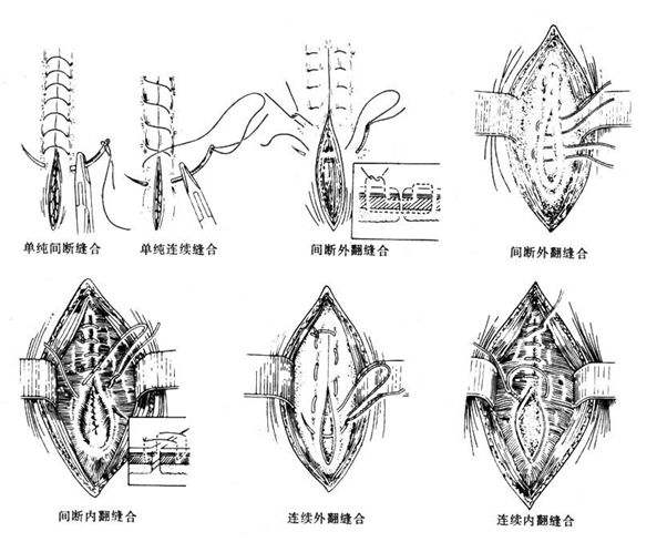 整形外科医生缝合的时候最起码要缝到三层:分别是肌肉层,脂肪层,真皮