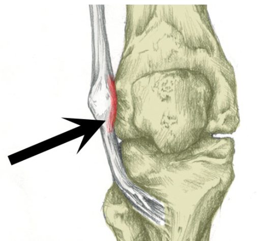 膝关节外侧痛髂胫束综合征