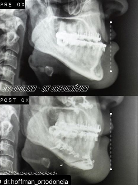 (参考国外医生反颌案例:正颌手术,下颌升支,矢状劈开 颏成型手术)