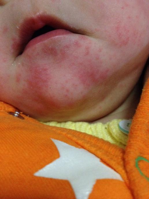 麻烦您给看看孩子下巴长的这些红色疹疹是什么呀?
