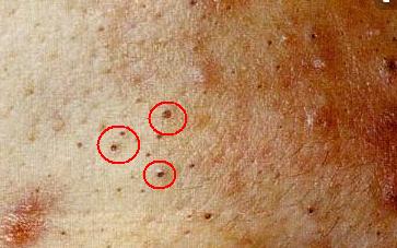 粉刺攻坚战 | 对战"白头粉刺"新攻略!