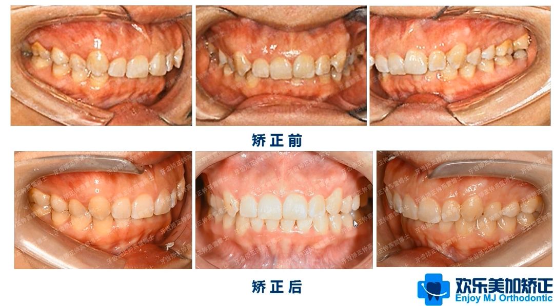 上牙提上去后,牙槽骨和牙龈也明显的跟着提上去了.