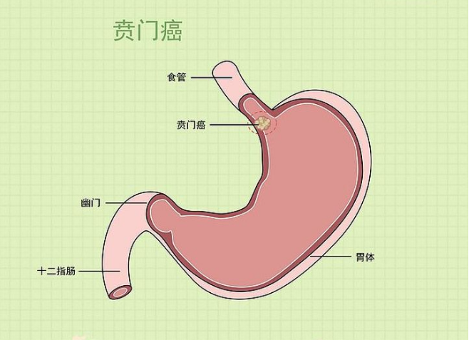 贲门癌的中期症状图片图片