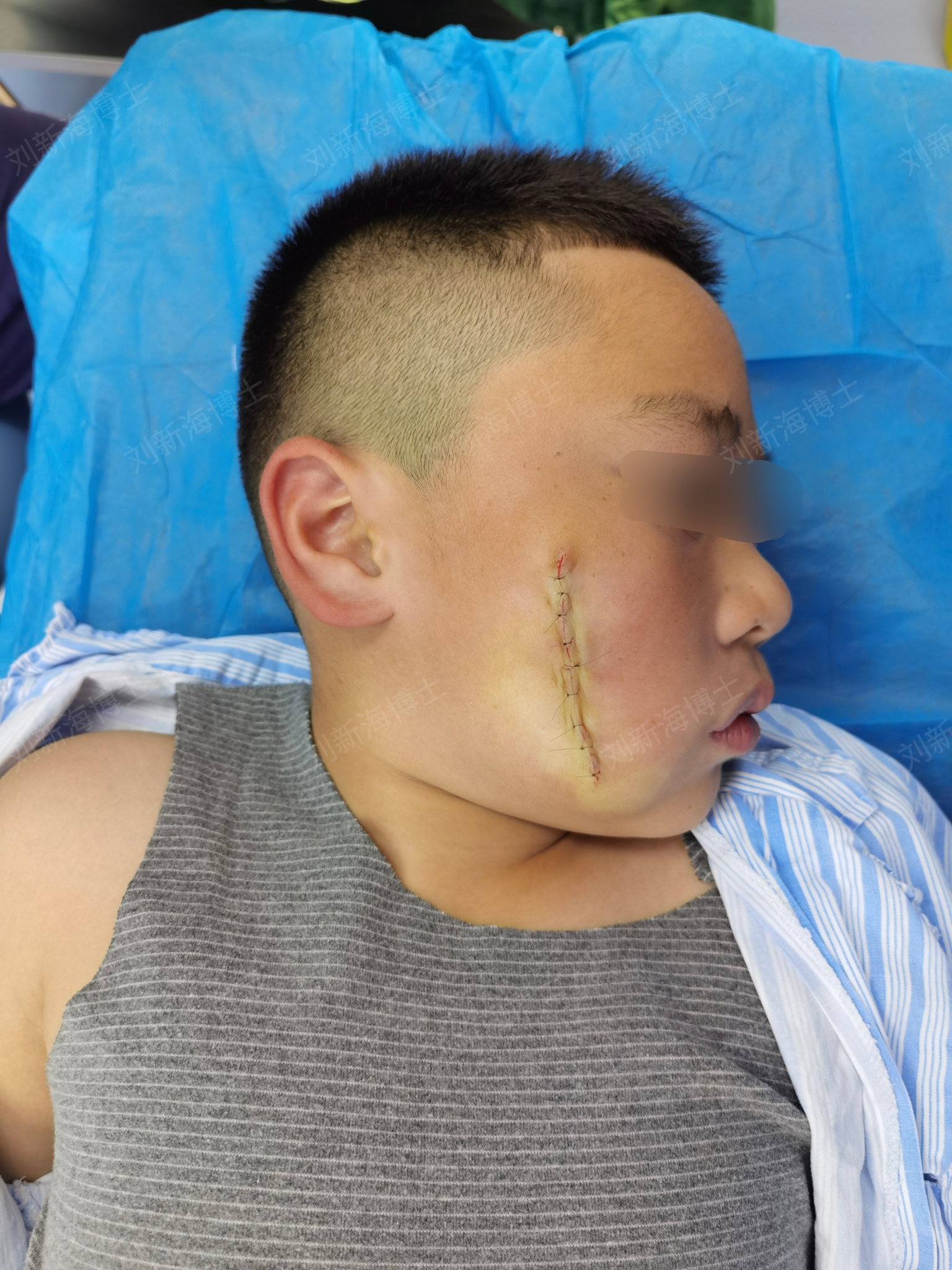 防复发痣祛除术术后即刻效果