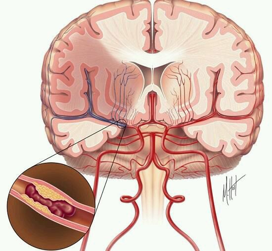 缺血性脑卒中的核心问题